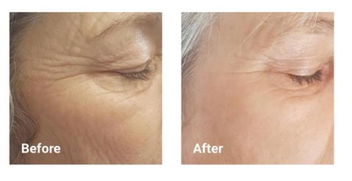 Before After Totally Derma Before After Totally Derma