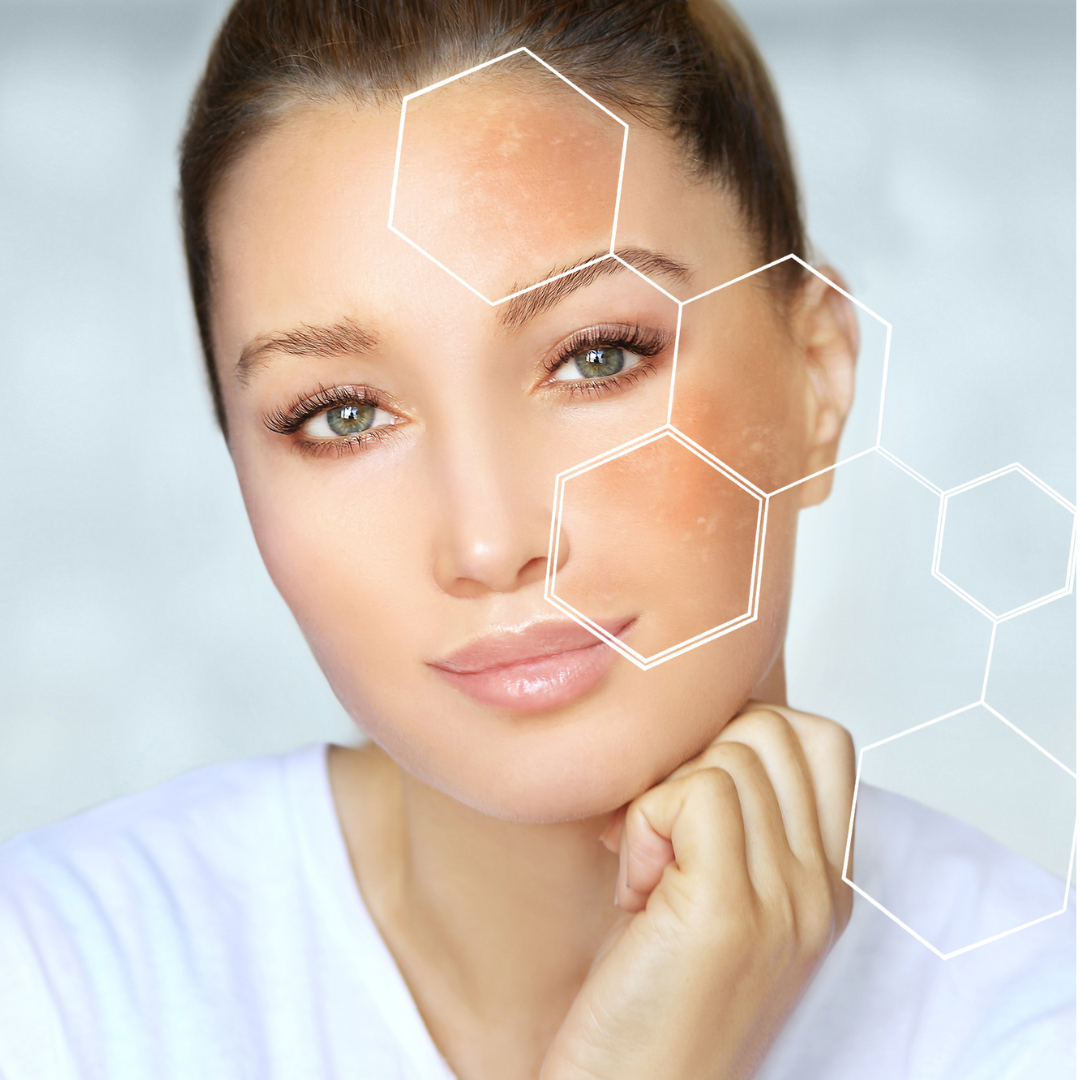 Treat Pigmentation with Skincare Blog Image