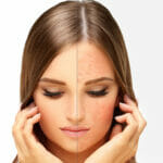 What is Rosacea What is Rosacea