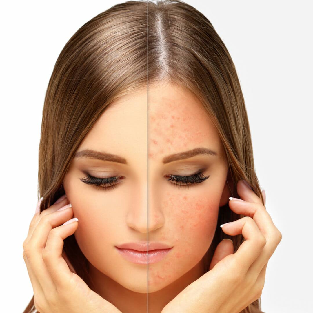 What is Rosacea