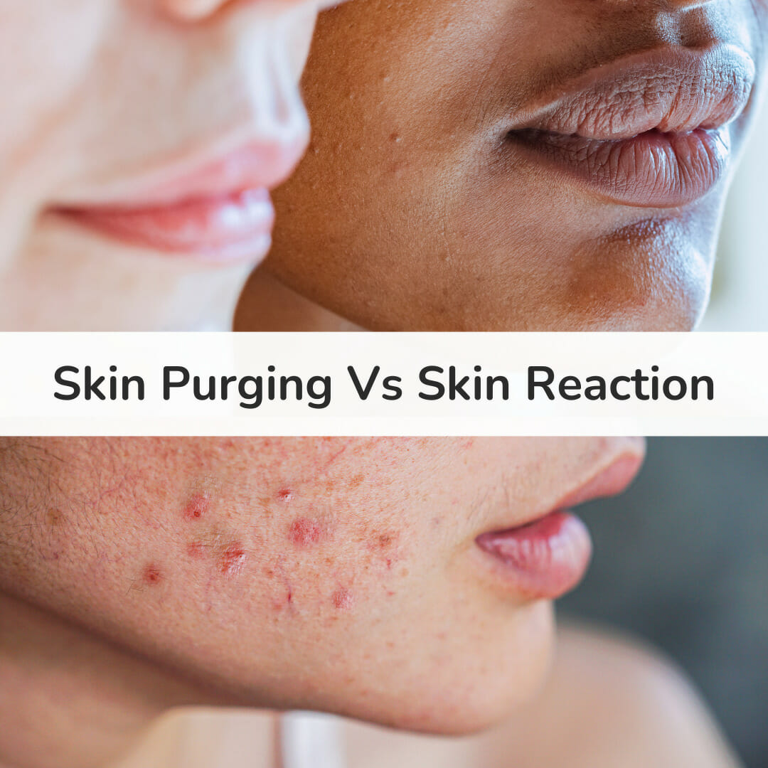 Skin Purging vs Skin Reaction