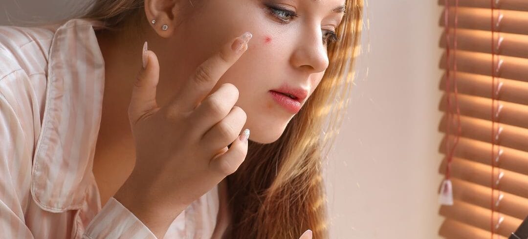 What are the key ingredients I should look for in acne products