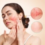 Causes, Symptoms, and Skincare Solutions Causes, Symptoms, and Skincare Solutions