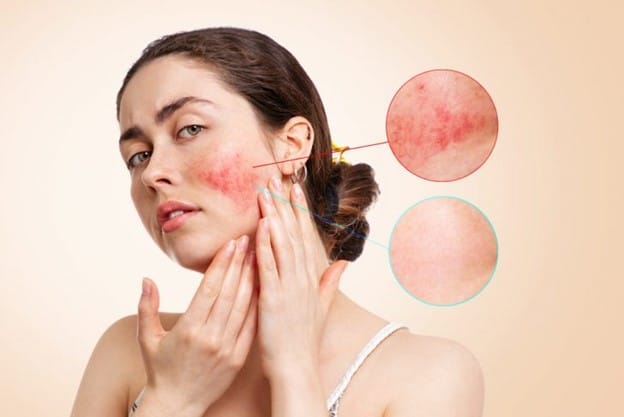 Causes, Symptoms, and Skincare Solutions